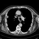 Metastatic disease of lung, pleural metastases: CT - Computed tomography